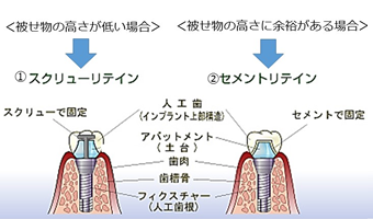 インプラント