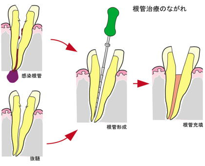 根管治療