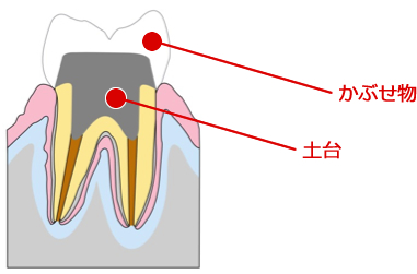 根管治療