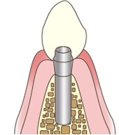 インプラント