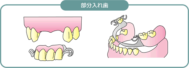 部分入れ歯